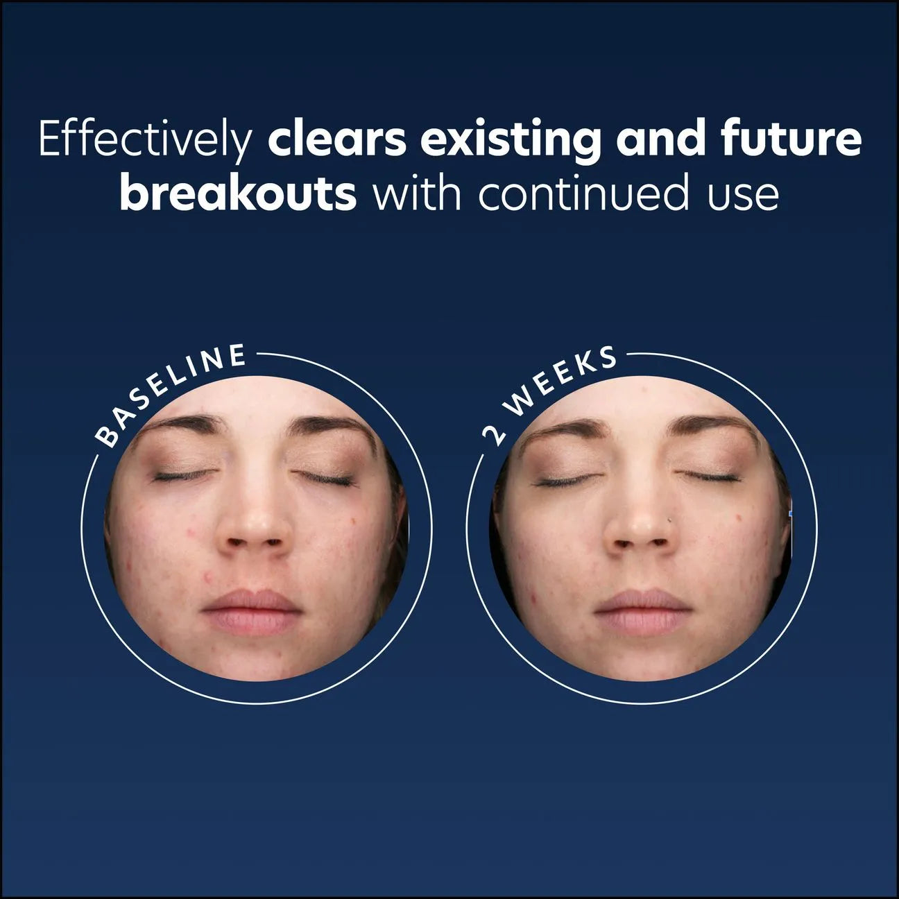 Acne gel - PCA Skincare