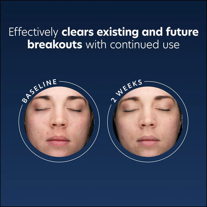 Acne gel - PCA Skincare